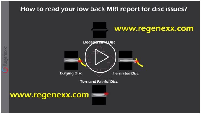 Read a Low Back MRI Report in 2 Minutes