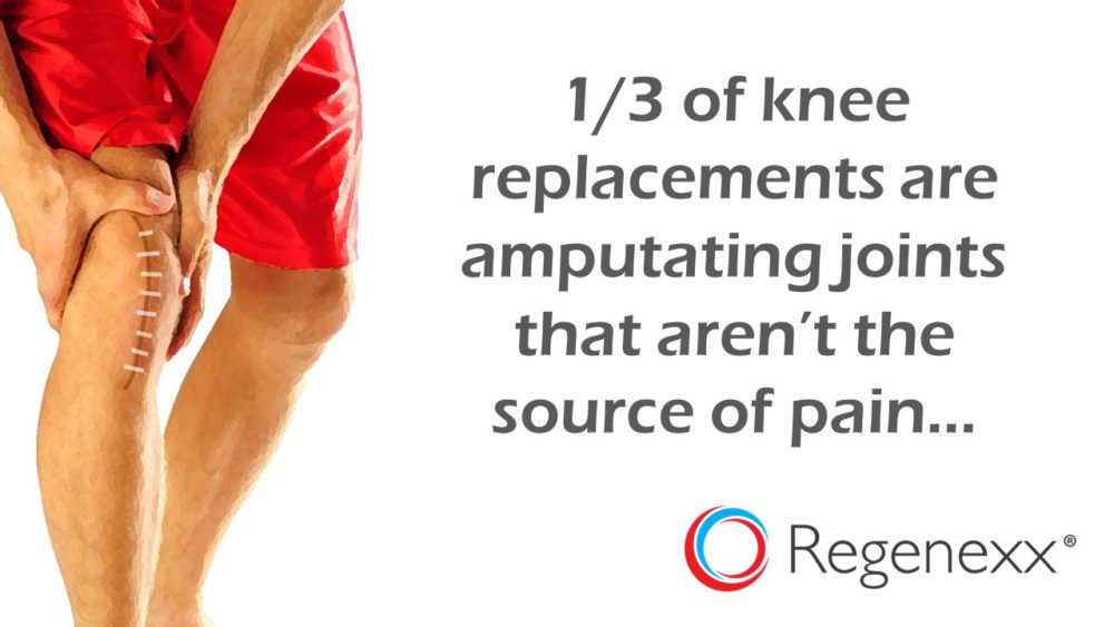 Chronic Knee Replacement Pain: 1/3 of the Time Knee Replacement Surgery Removes a Knee Joint that Isn’t Painful?
