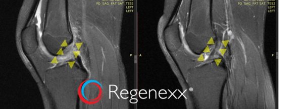 Two MRIs showing a torn ACL before and after stem cell injections