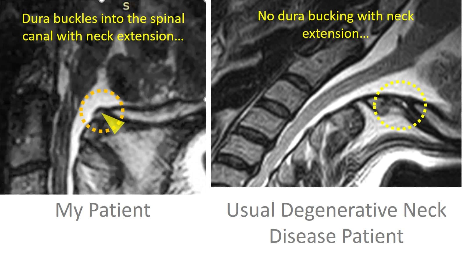 dura buckling with neck extension