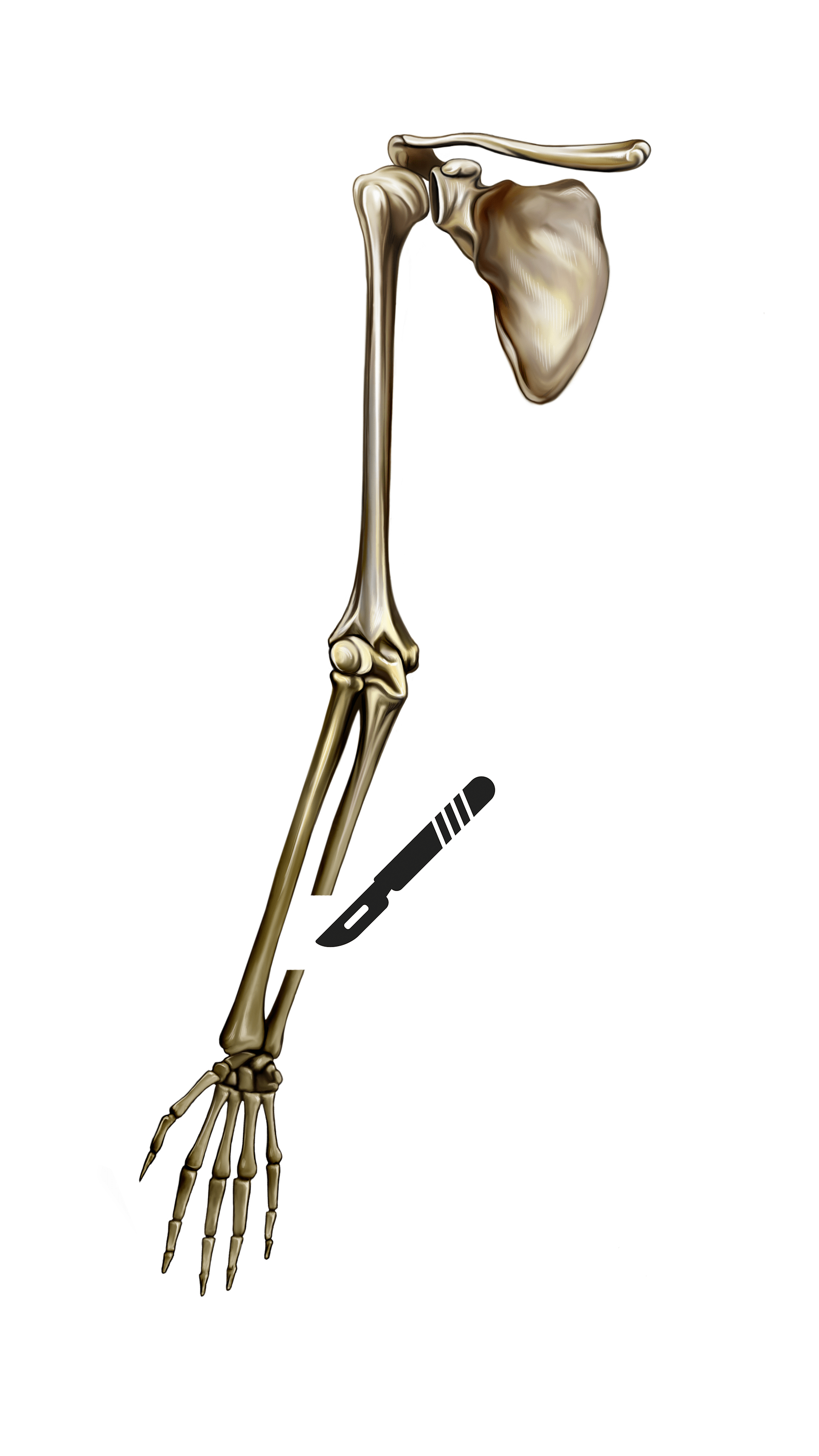 ulnar-shortening