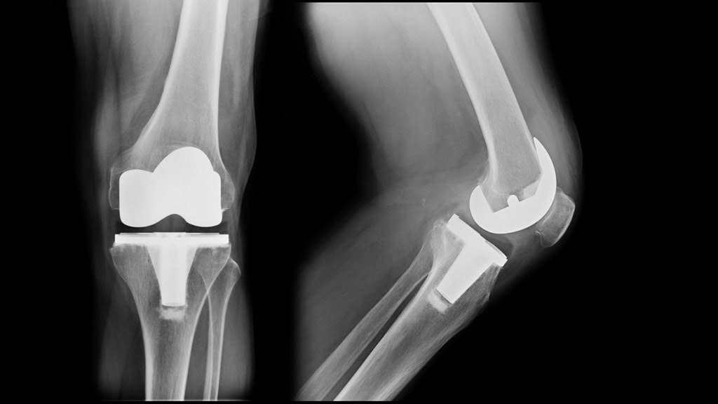 the-number-of-knee-replacement-risks-increases