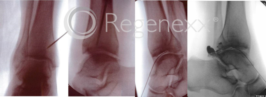 interventional orthopedics new ankle surgery alternative