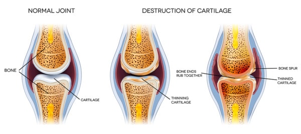 Medical illustration showing a healthy knee joint and two stages of knee arthritis.