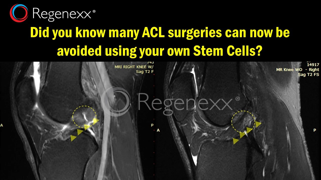 acl surgery new procedure