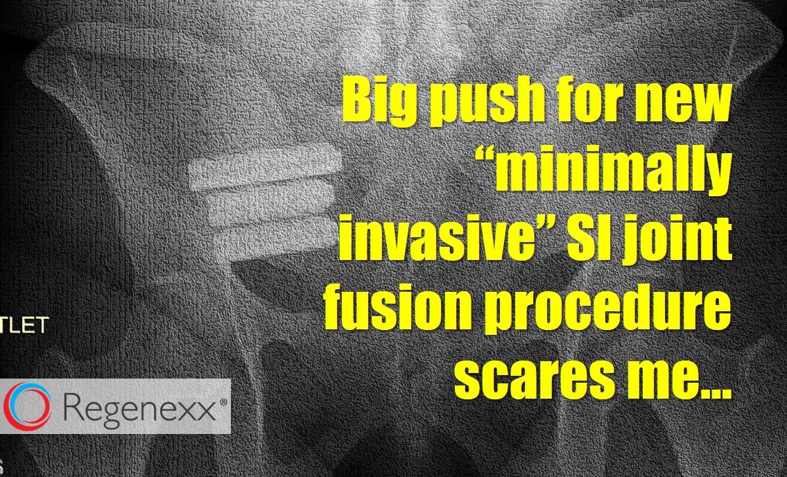 SI Joint Fusion Results, ifuse Surgery Reviews Regenexx Blog