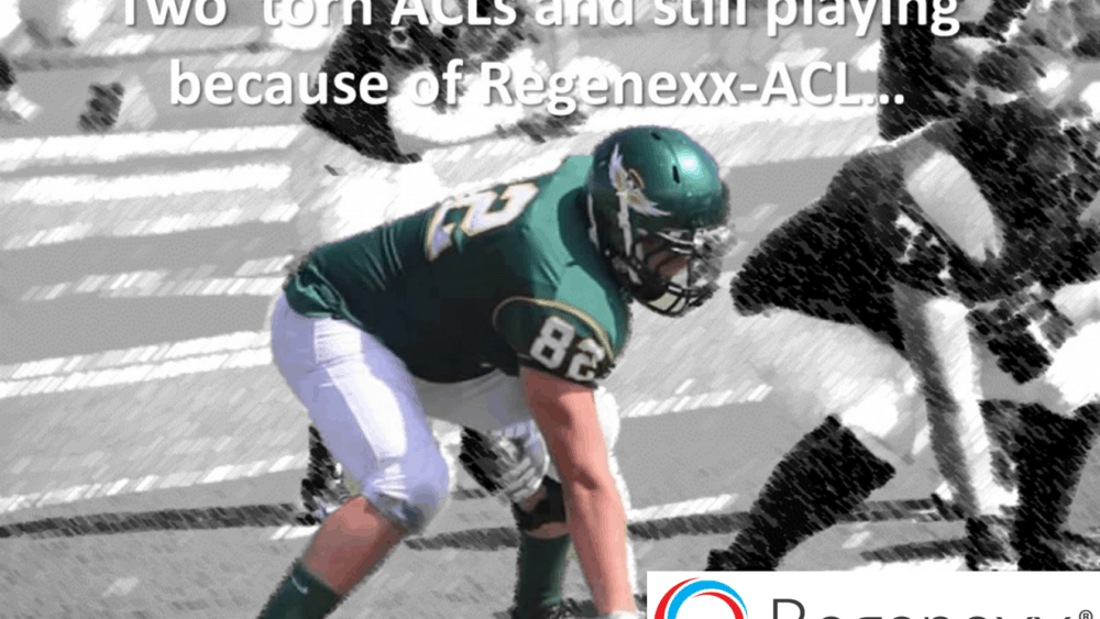 ACL Tear Treatment: Helping a College Football Player Avoid Surgery
