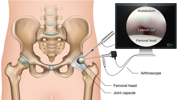 Medical illustration showing a hip arthroscopy