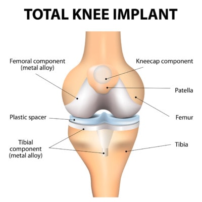 Medical illustration showing a knee implant.