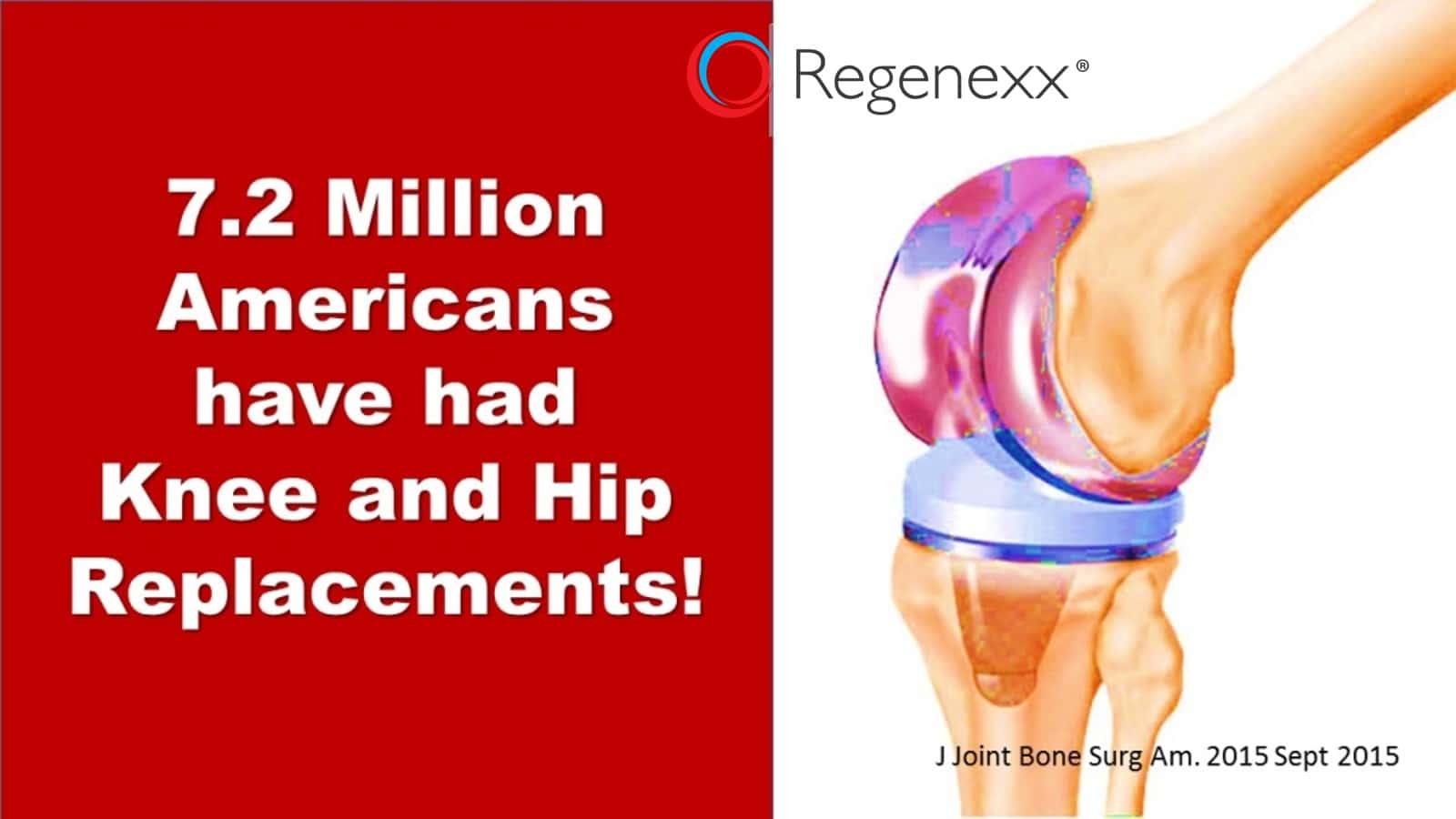 7 Million Americans Have Had Knee And Hip Replacements Regenexx®