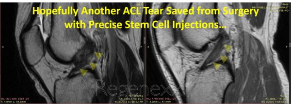 Two MRIs of the knee with text overlay reading: Hopefully Another ACL Tear Saved from Surgery with Precise Stem Cell Injections