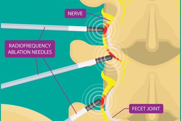 Medical infographic showing Radiofrequency ablation needles treating nerves in the spine