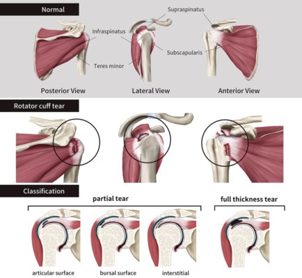 Medical infographic showing a three views of a healthy rotator cuff and the various stages of a tear