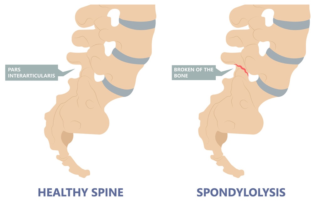 Spondylolysis Treatment Options