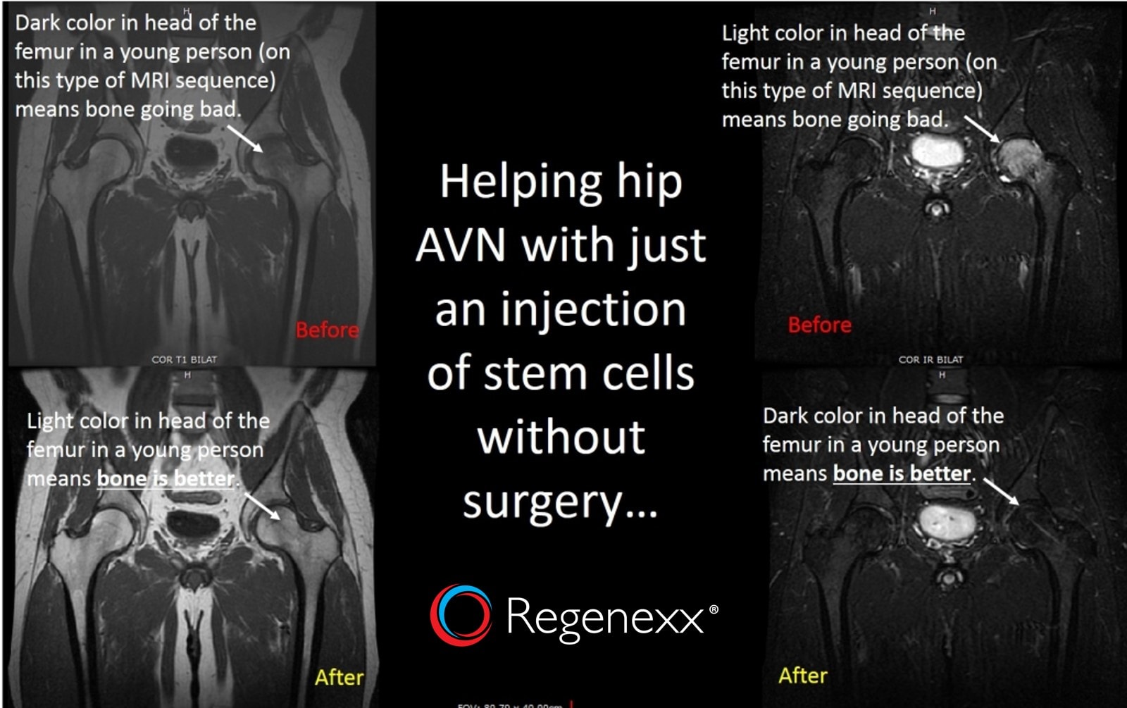 Hip Avn Surgery Alternative Another Hip Avn Patient Treated With Stem Cells Regenexx®