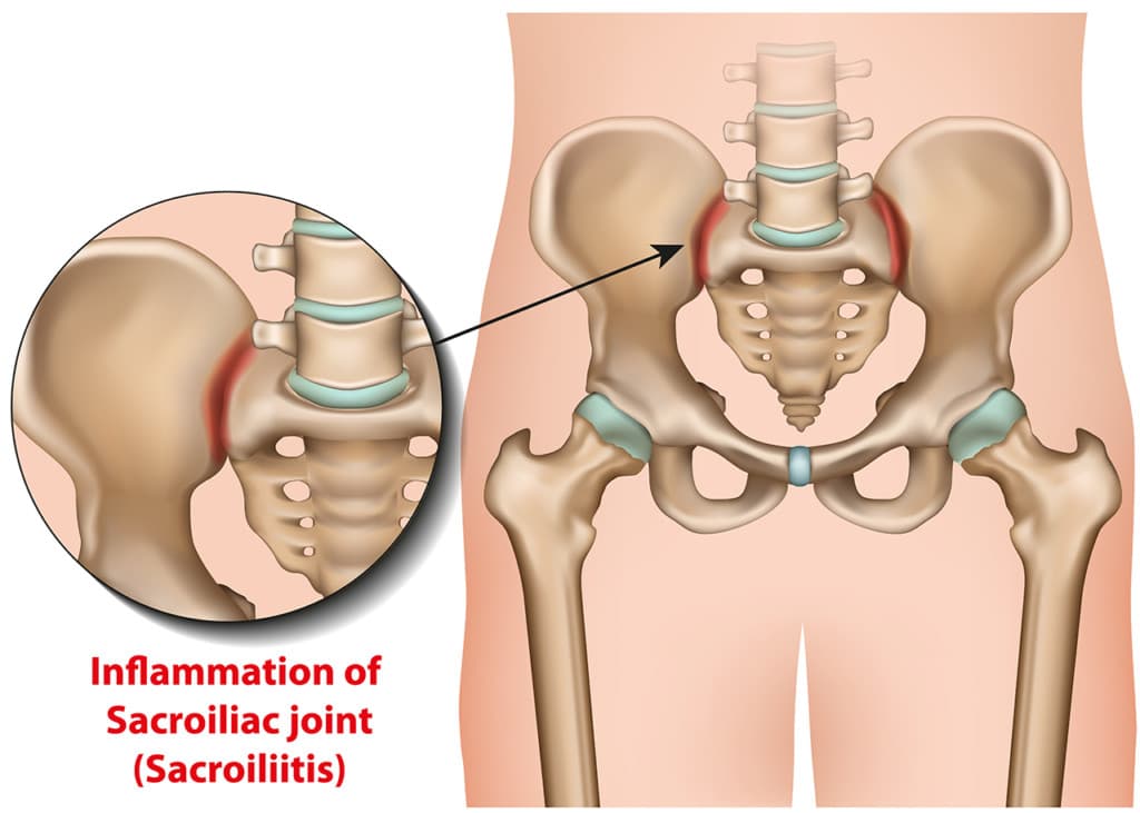 Medical illustration showing sacroiliac joint inflammation