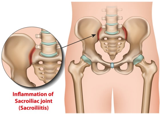 Medical illustration showing sacroiliac joint inflammation