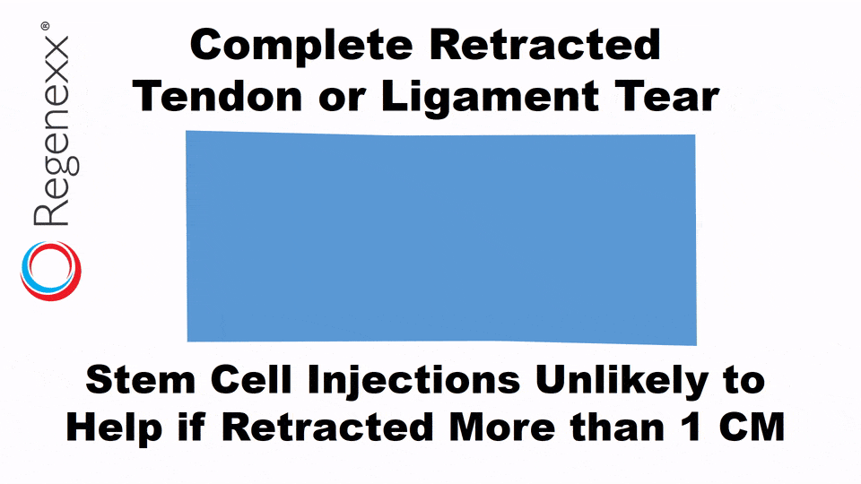 complete retracted tendon or ligament tear