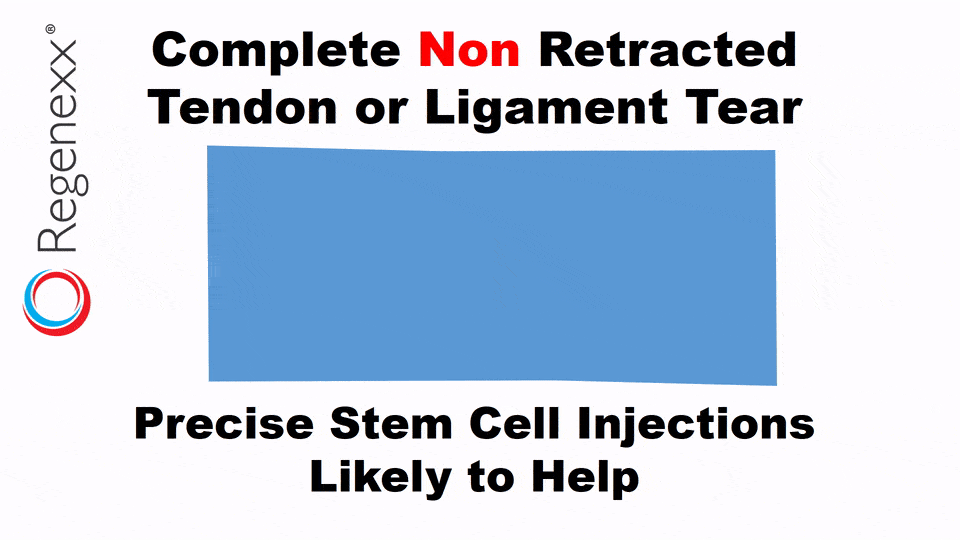 Complete nonretracted tendon or ligament tear