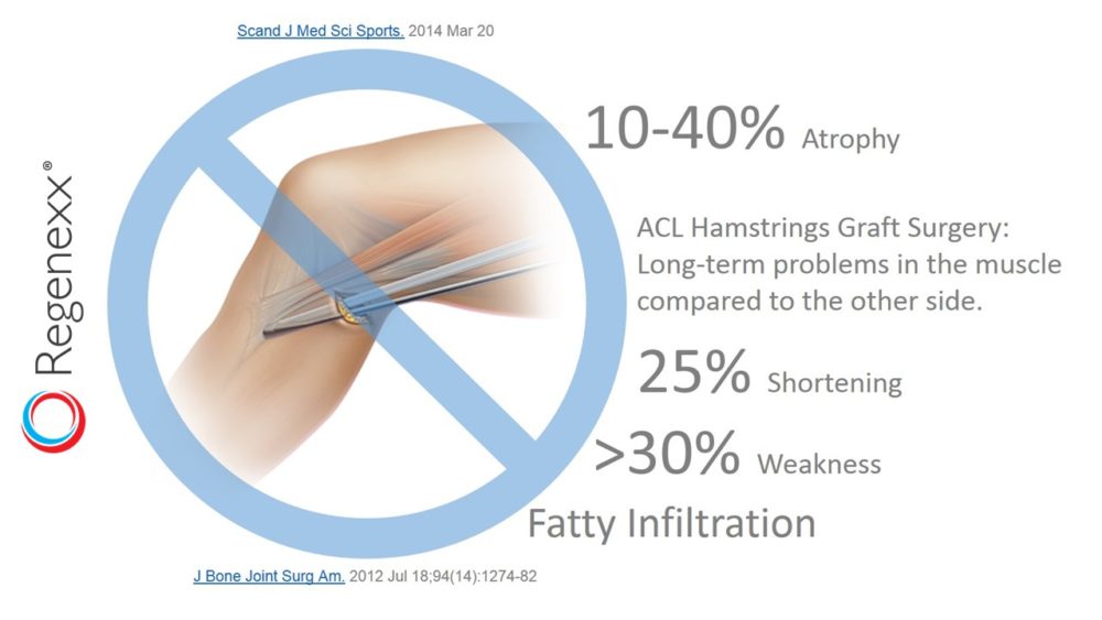 Hamstring ACL Surgery Complications: Problems in the Hamstring after Surgery