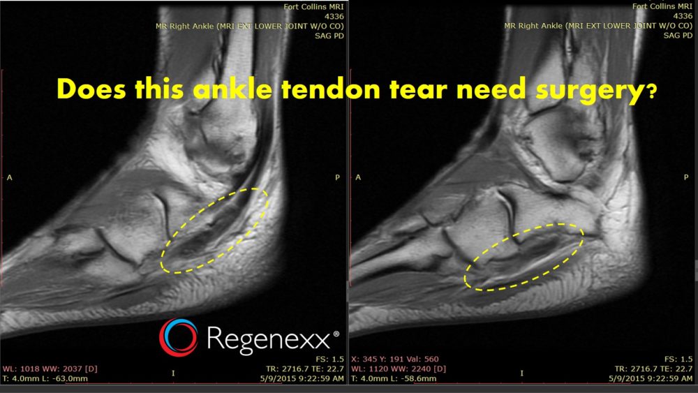 How to Heal a Torn Tendon Naturally: The Type of Tear Matters
