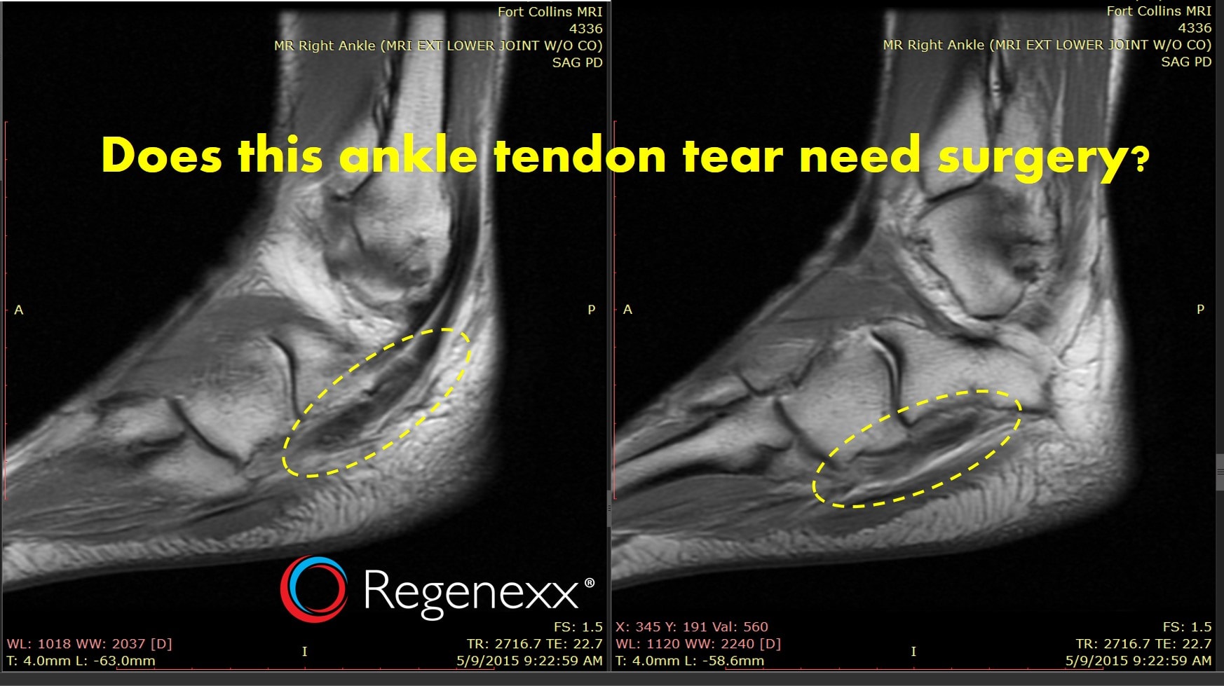 can-torn-tendons-heal-naturally-depends-on-the-type-regenexx