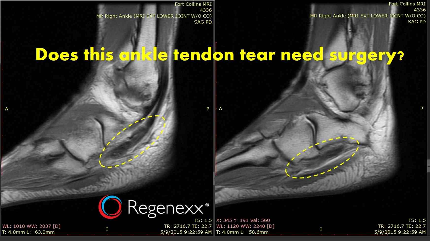 mri of torn tendon in left ankle