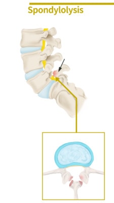 Medical illustration showing a portion of the spine affected by spondylolysis