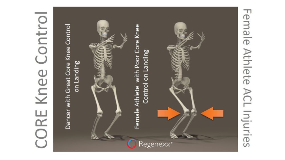 Women’s Soccer ACL: Why Do Women Athletes Injure their ACL Ligaments More than Men?