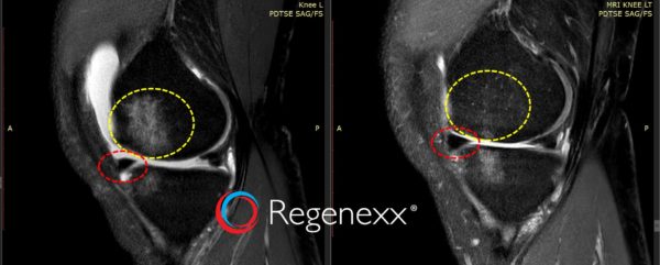 MRIs of the knee showing the progress of arthritis before and after stem cell injections 