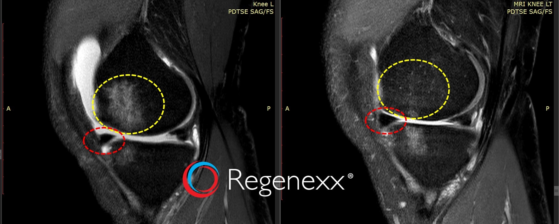 Culture Expanded Stem Cells for Knee Arthritis Regenexx®