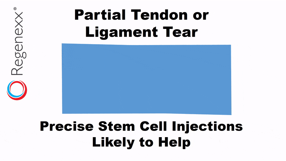 partial tendon or ligament tear