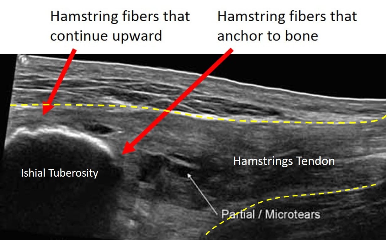 hamstrings ultrasound anatomy