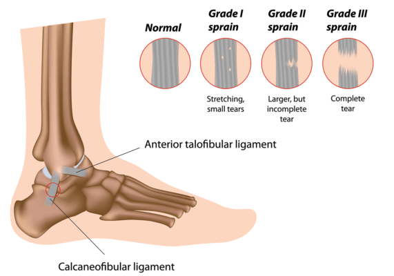Medical illustation showing the ligaments in the ankle with inset images showing a normal ligament and three grades of tears