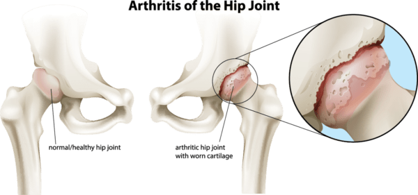 Medical illustration of the arthritis of the hip joint with a inset showing a close-up of the arthritic joint.