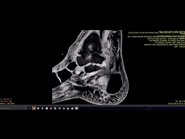 GIF zooming into an MRI of the heel and ankle
