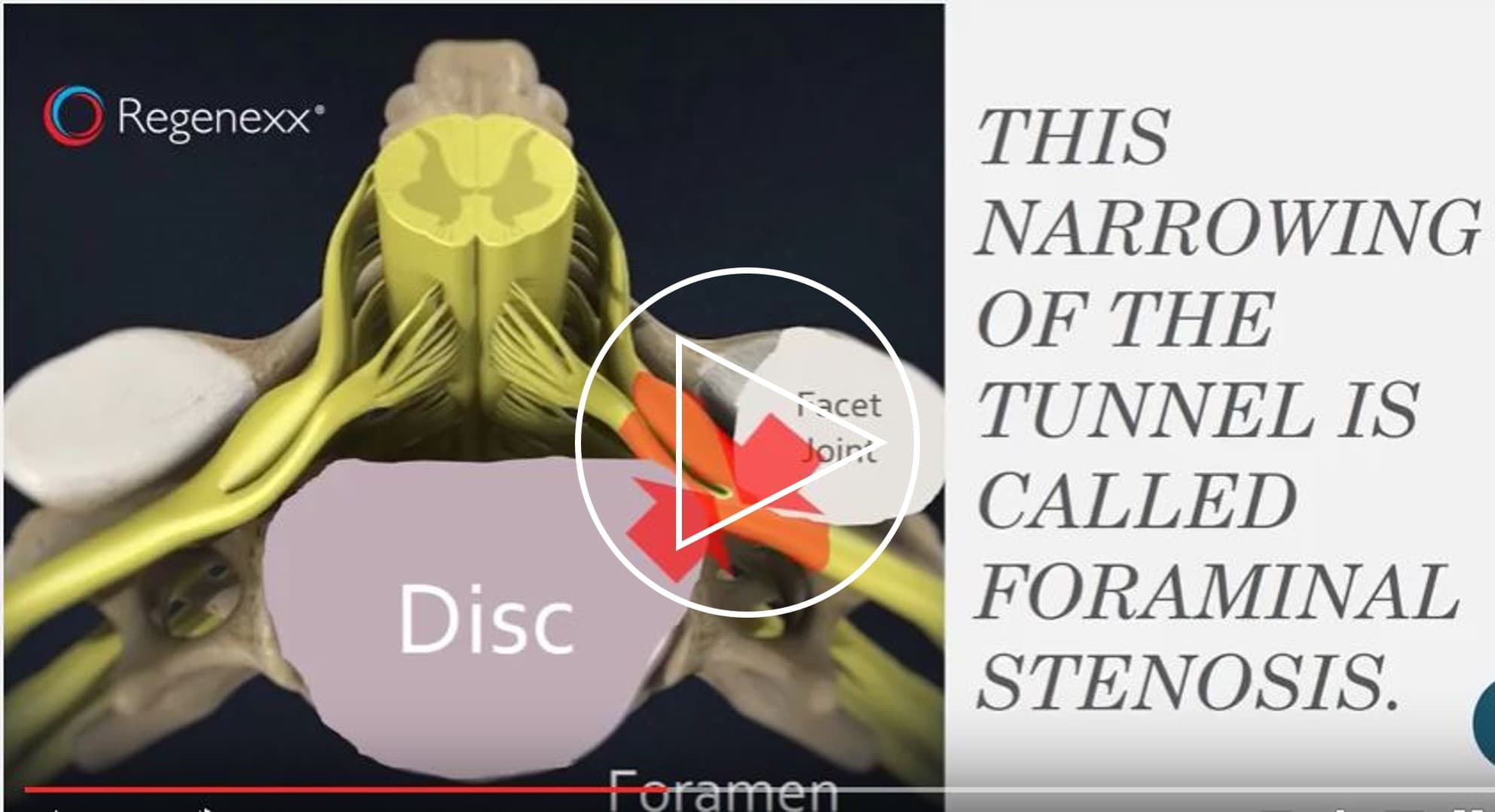 Bilateral Foraminal Stenosis C5 C6 | Health Checklist