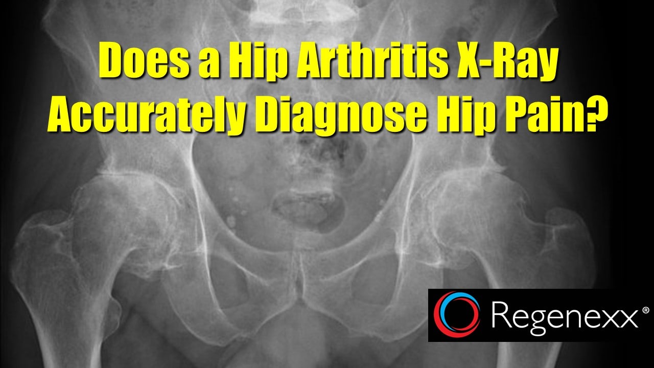 hip pain with normal xray