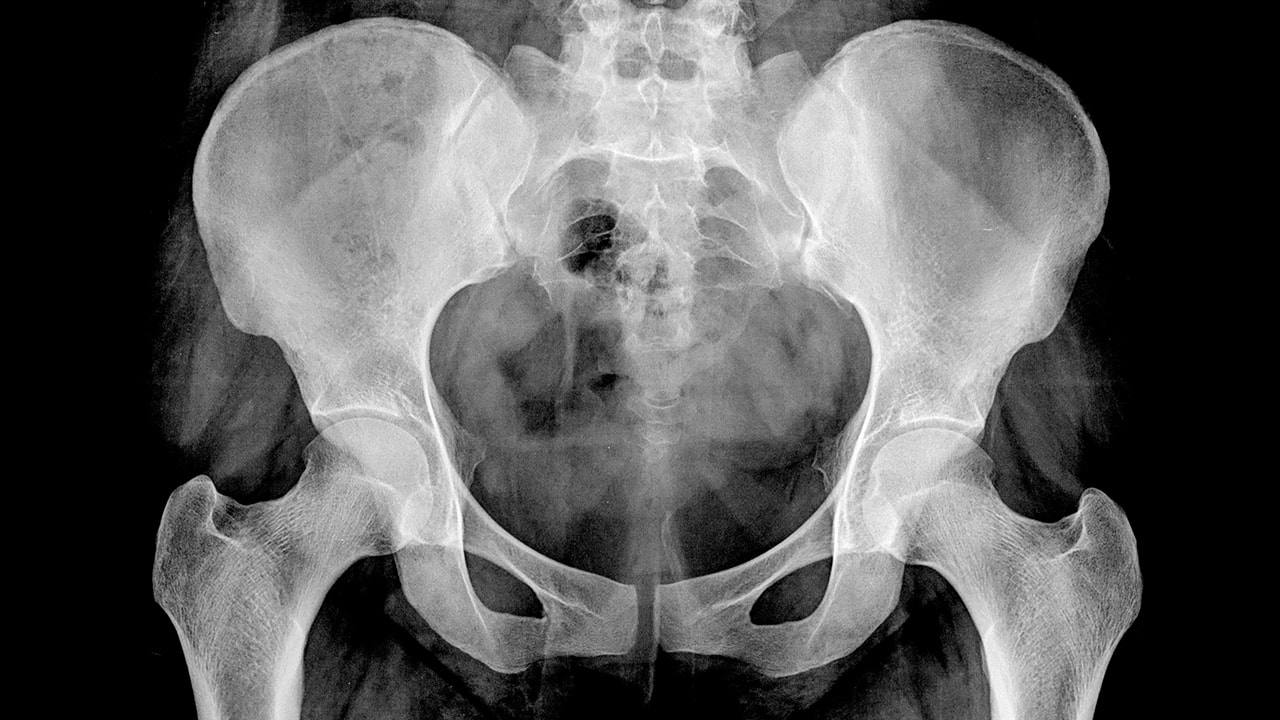 left hip xray normal moderate