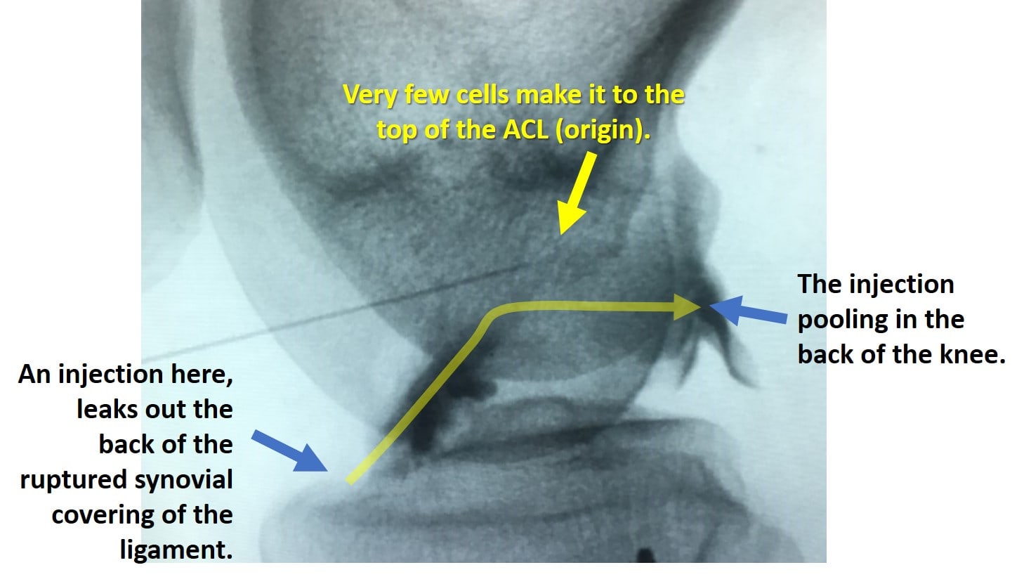 ACL injection fluoro