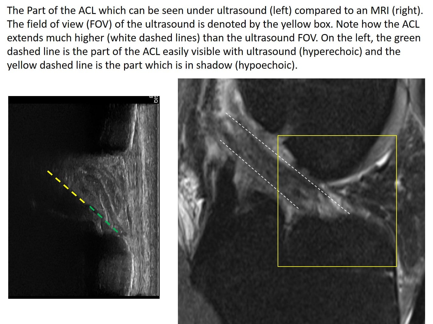 ACL mri vs ultrasound