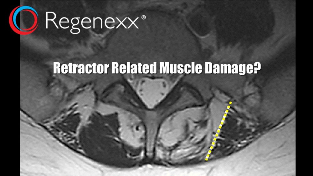 Back Surgery Gone Bad: Did Your Stabilizing Muscles Get Fried?
