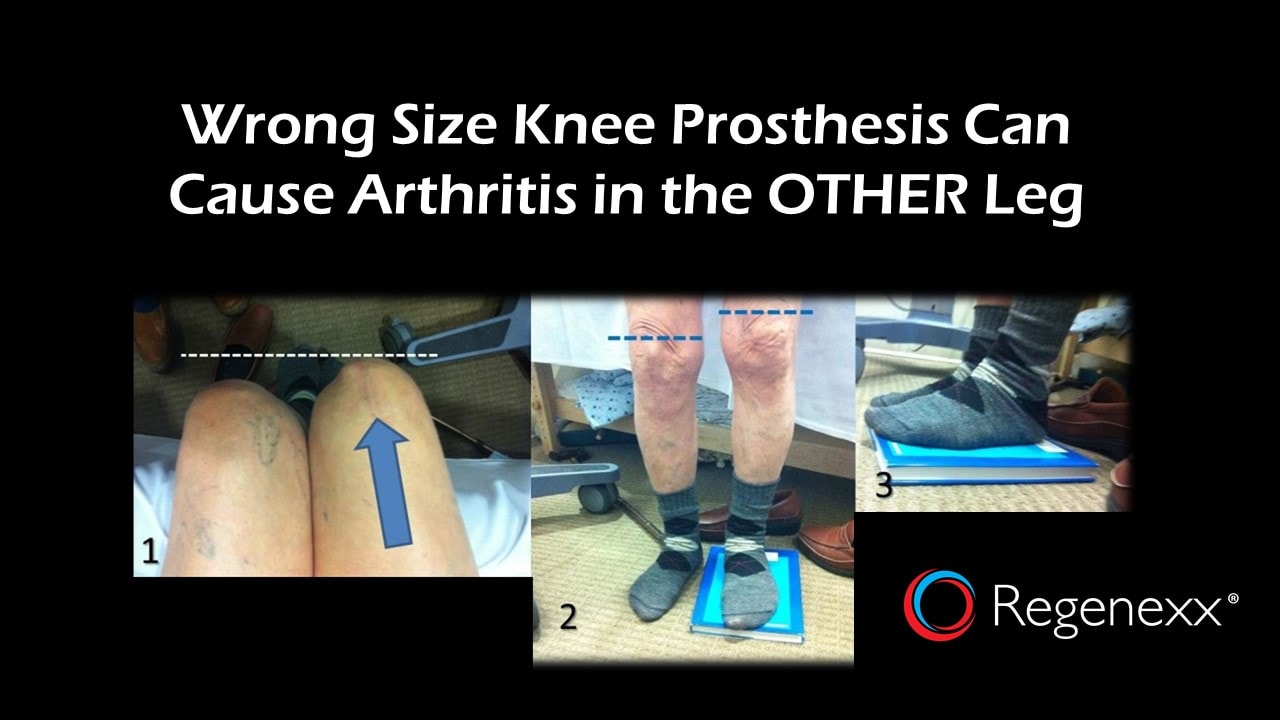 Hip and Knee Arthritis Pain Knee Replacement and a Long Leg