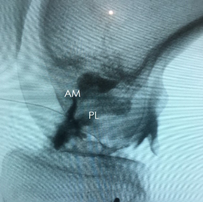 properly injected fluoro ACL