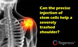 shoulder stem cell