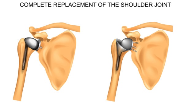 Medical illustration showing two full shoulder repalcements