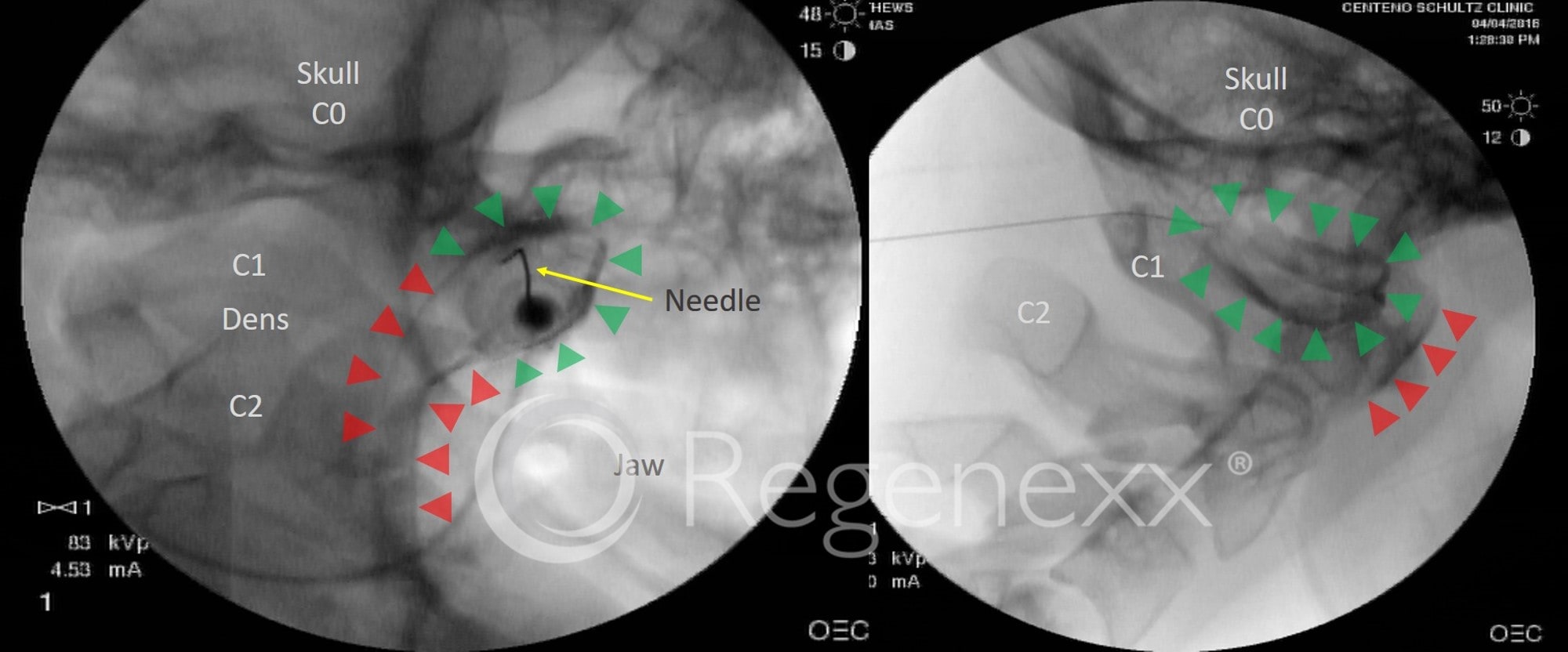 prolotherapy ccj instability keeping patients safe