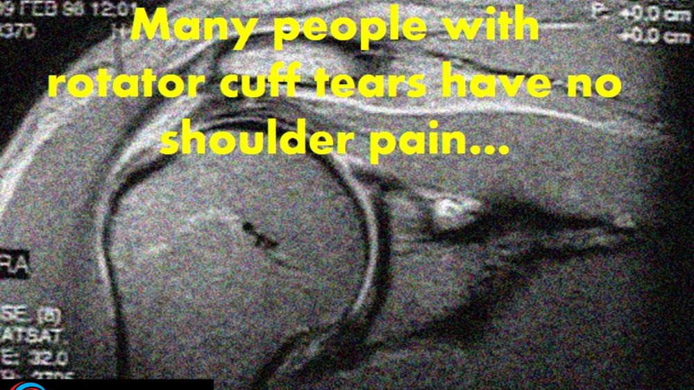 Do Shoulder Rotator Cuff Tears Hurt?