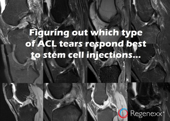 A grid of MRIs with the text: Figuring out which type of ACL tears respond best to stem cell injections...