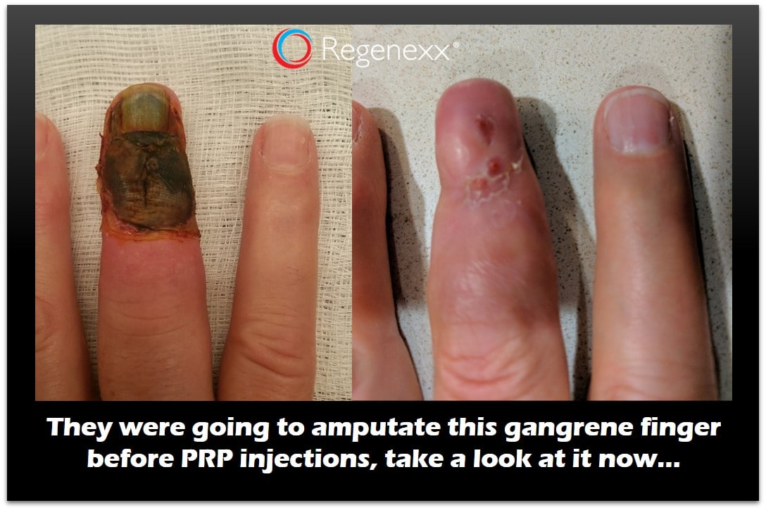 going amputate finger prp